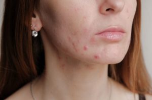 O que são as acnes
